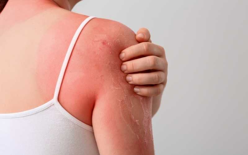 cloques-brulures-soleil